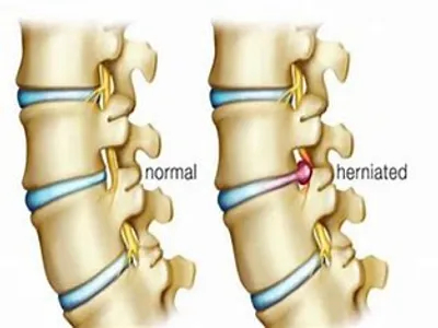 Herniated Disc Treatment In Chile